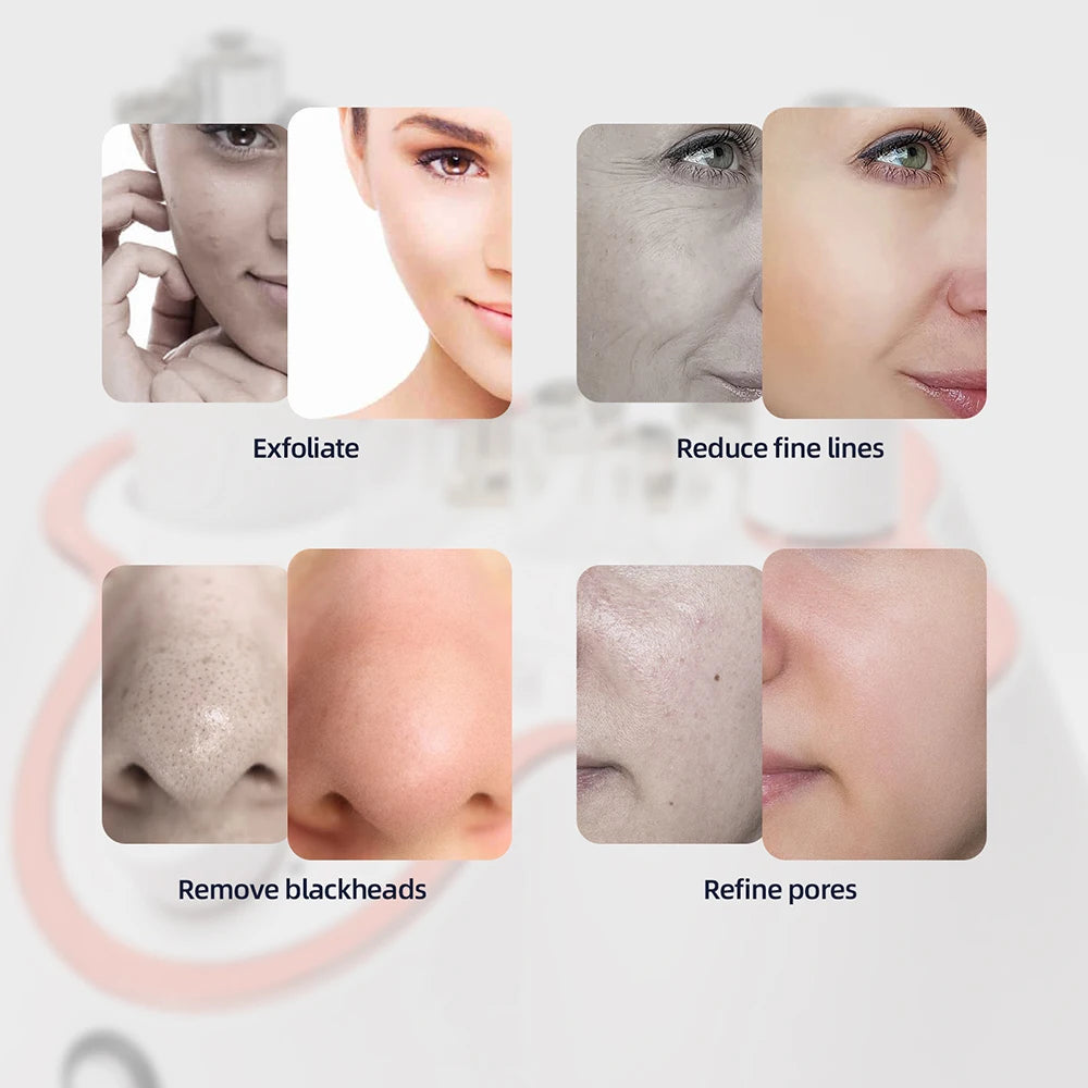 Foreverlily 3 in 1 Diamond Microdermabrasion Machine Water Spray